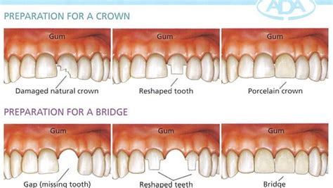 Dental Bridges and Crowns near Rosebud .